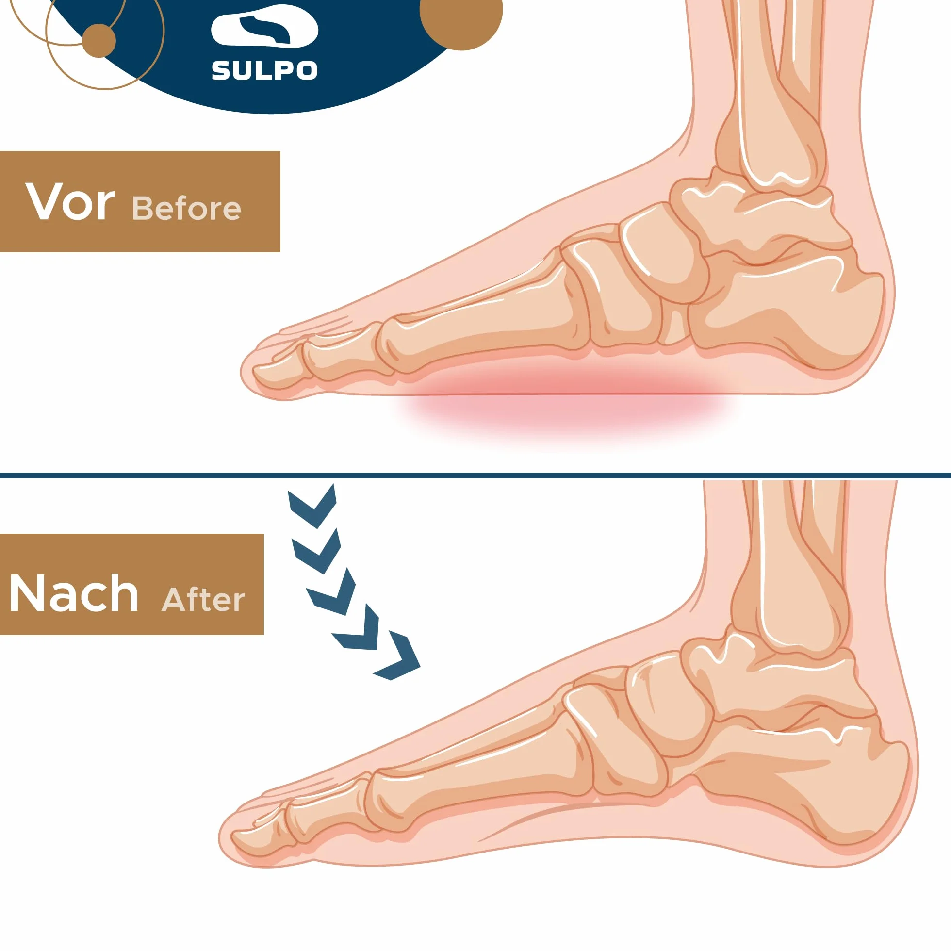 SULPO Talloniera per spina calcaneare - 3/4 Solette ortopediche per tallonite e piedi piatti - Proteggi tallone per scarpe - Cuscinetti tallone per fascite plantare e il dolore ai piedi - 36-39 / M