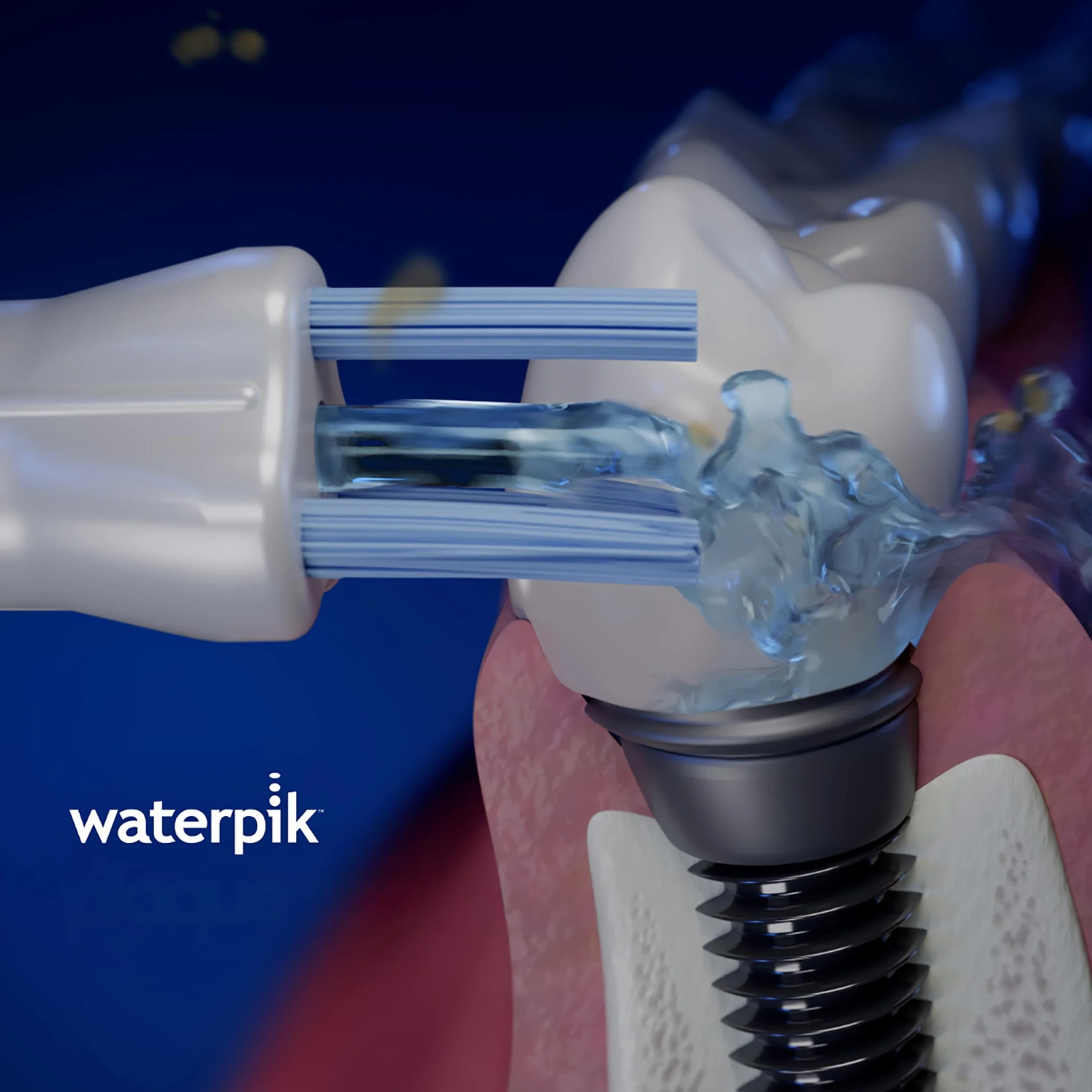 Waterpik Testina Plaque Seeker PS-100E, Testine di Ricambio per Protesi Dentarie, Corone e Ponti, Confezione da 2