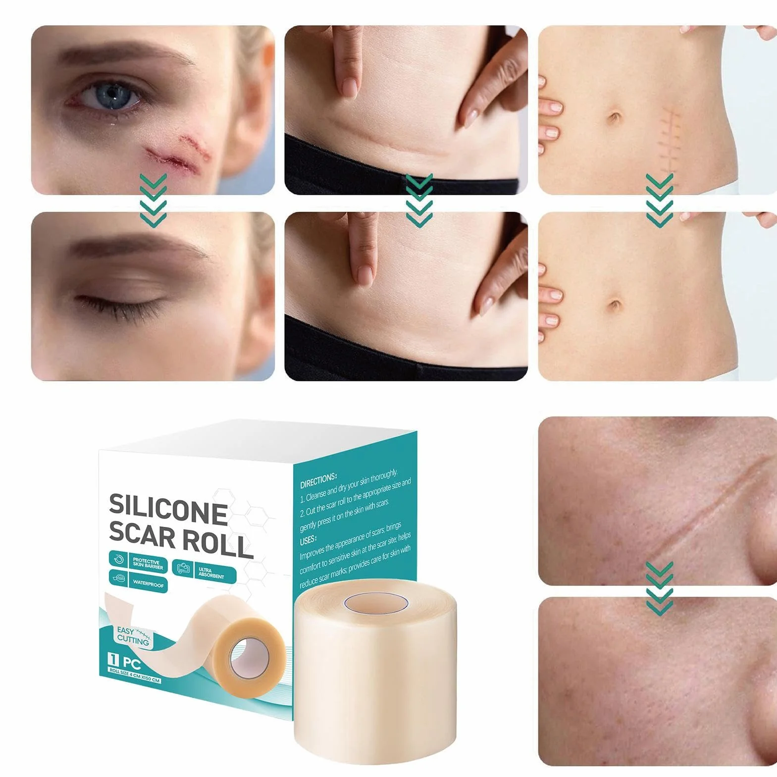 Fogli di cicatrici in silicone per viso, nastro guarigione ustioni, strisce riparazione veloce
