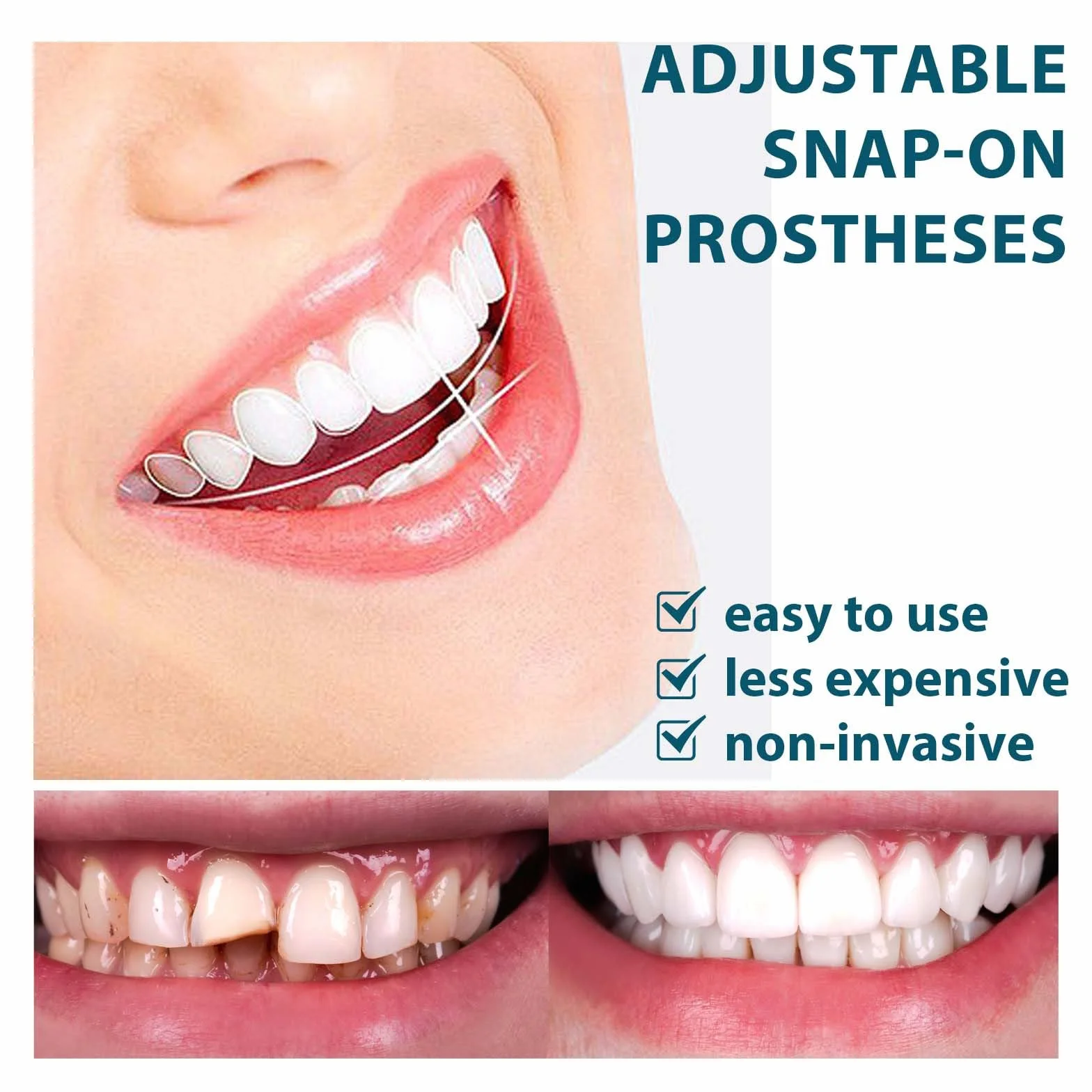 Protesi in silicone ultrasottili con fibbia regolabile per denti invisibili