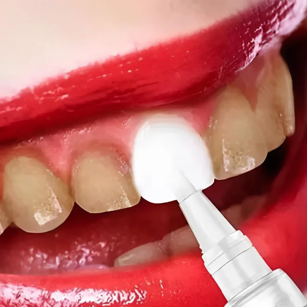 Penna Sbiancante Denti 2 Pezzi, Sbiancamento Rapido Efficace, Rimuove Macchie Dentali