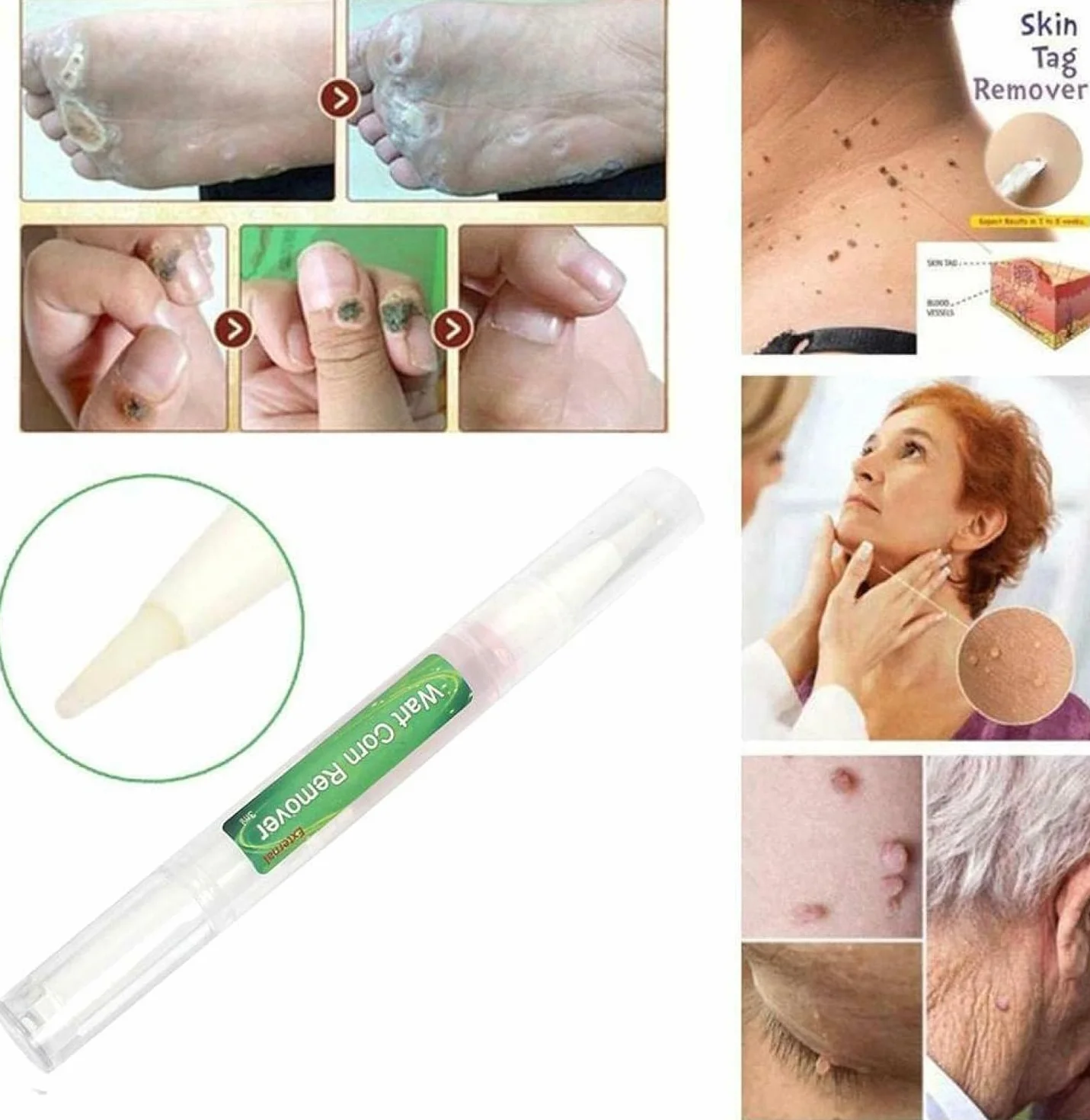 Genital Wart Treatment Papillomas Removal Liquid Wart Remover Pen 3ml