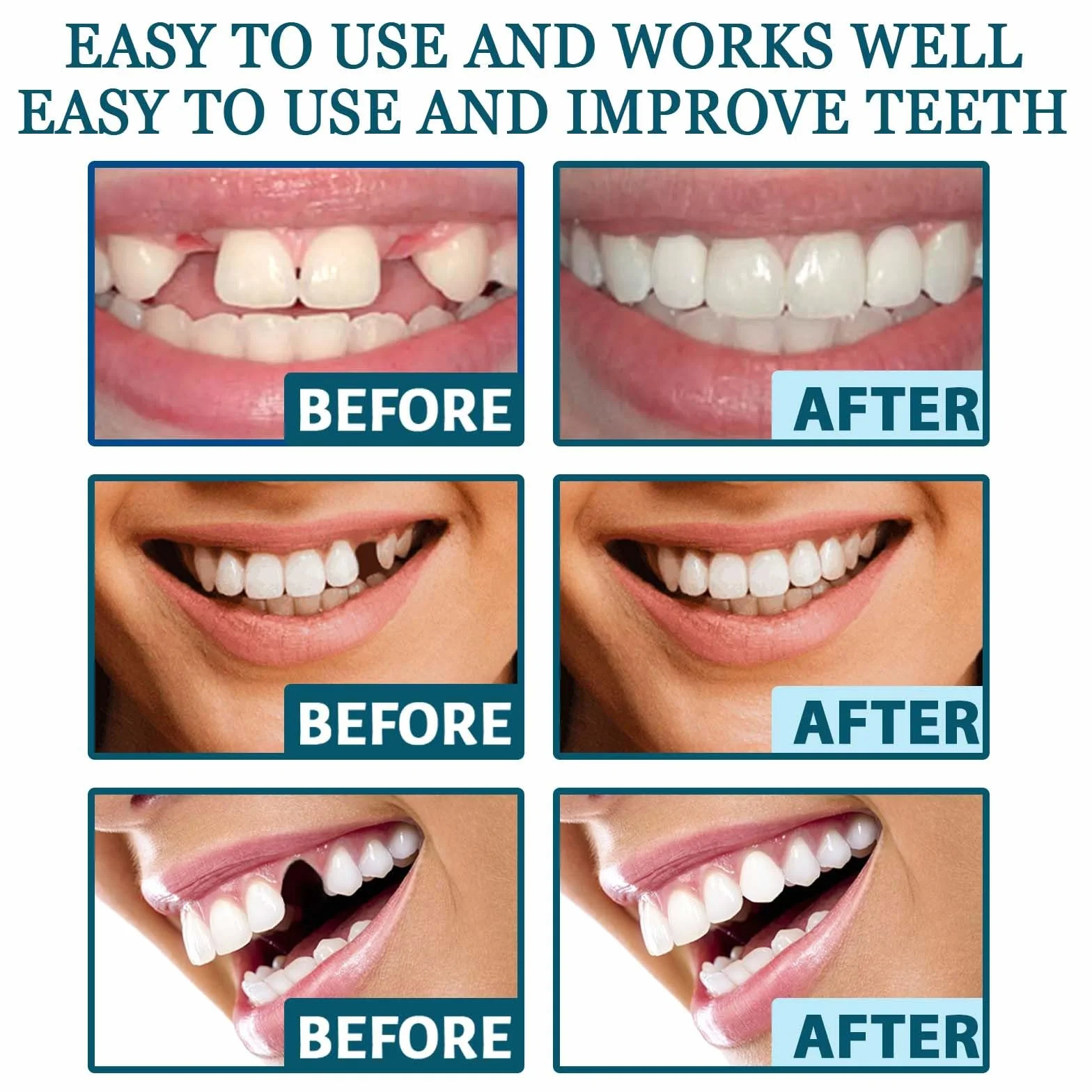 Protesi in silicone ultrasottili con fibbia regolabile per denti invisibili