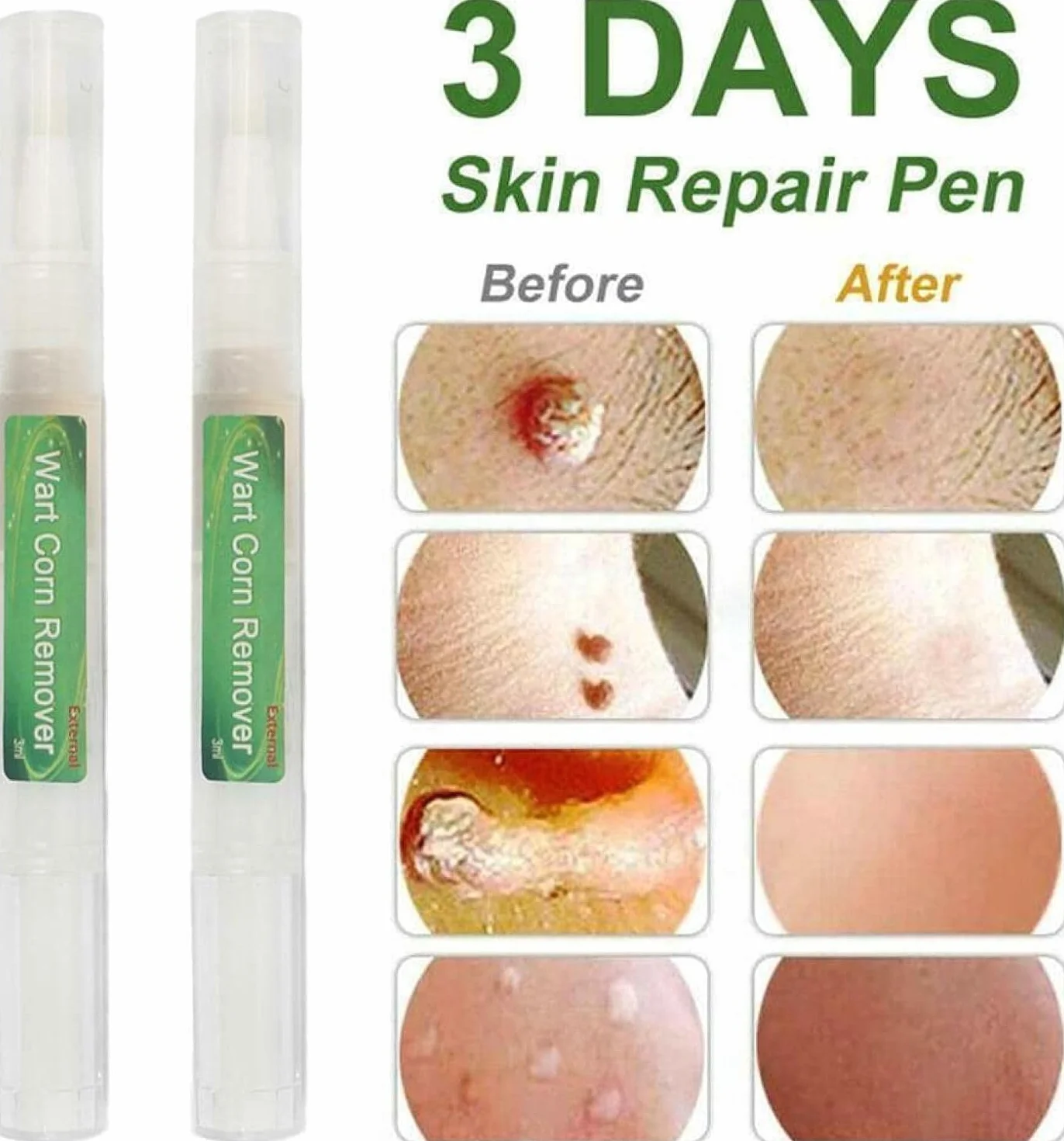 Genital Wart Treatment Papillomas Removal Liquid Wart Remover Pen 3ml