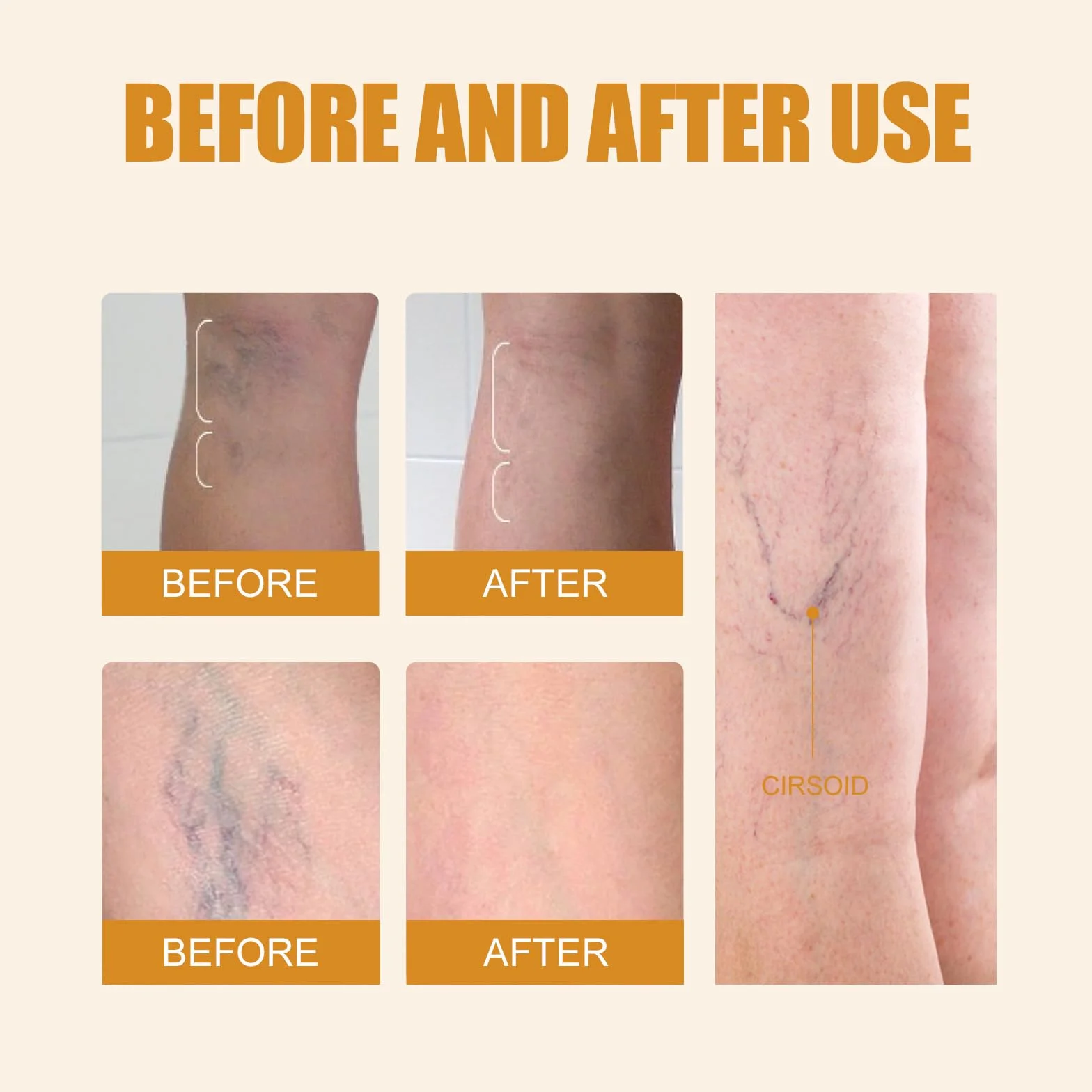 Generico Dispositivo Non Invasivo per Il Trattamento delle Vene Varicose, Apparecchiatura Laser per Il Trattamento delle Vene Varicose, Dispositivo Laser per Vene Varicose A Domicilio (1x - Single)