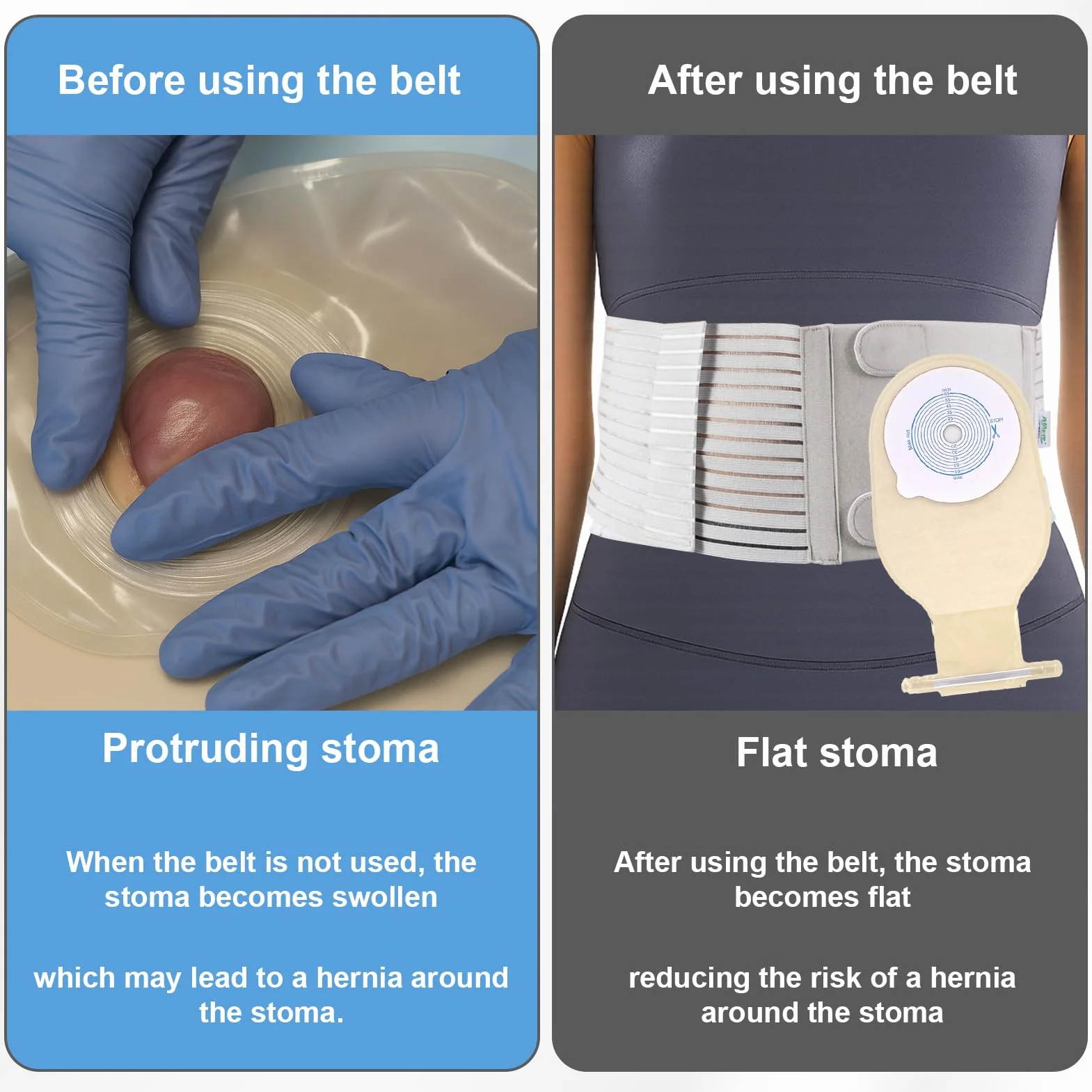 Cintura Per Stomia Da Uomo E Donna, Fascia Per Stomia, Cintura Addominale Post Colostomia, Fascia Addominale Post Operatoria, Prevenzione Delle Ernie Para-Stomali, L