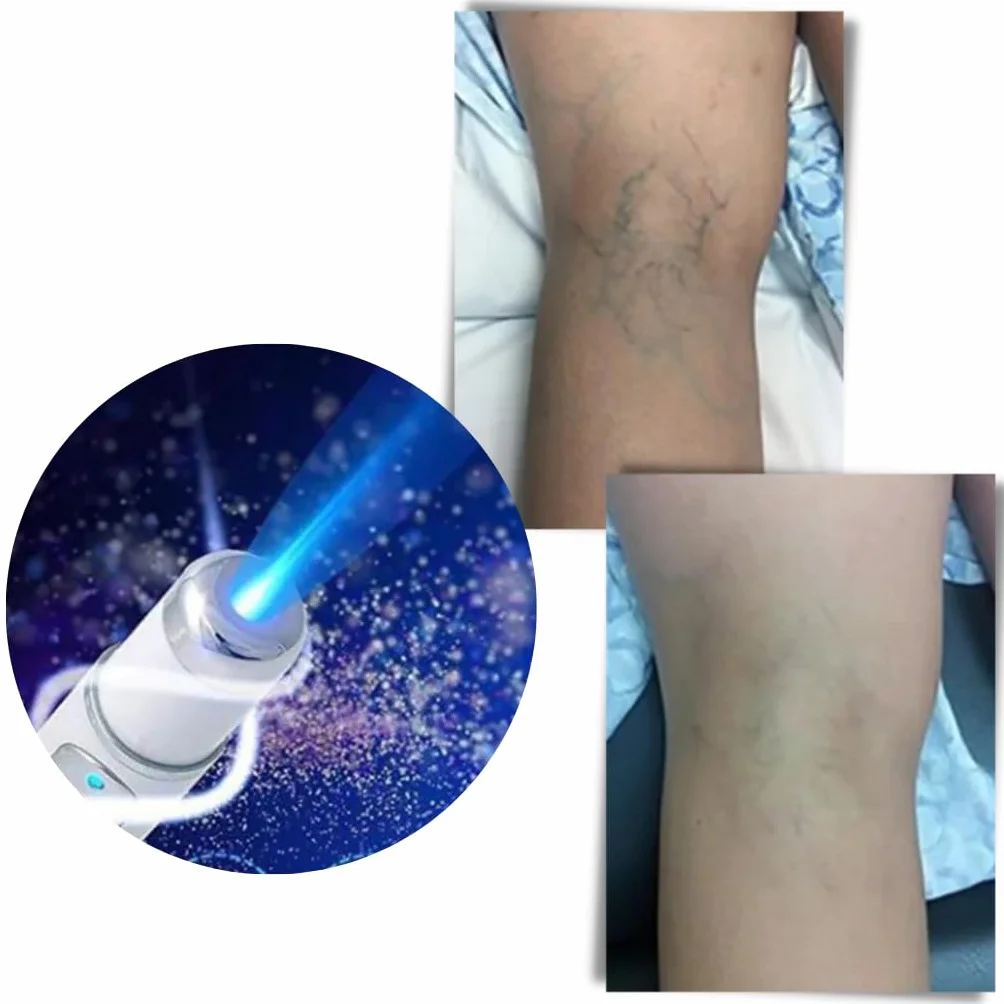 Generico Dispositivo Non Invasivo per Il Trattamento delle Vene Varicose, Apparecchiatura Laser per Il Trattamento delle Vene Varicose, Dispositivo Laser per Vene Varicose A Domicilio (1x - Single)