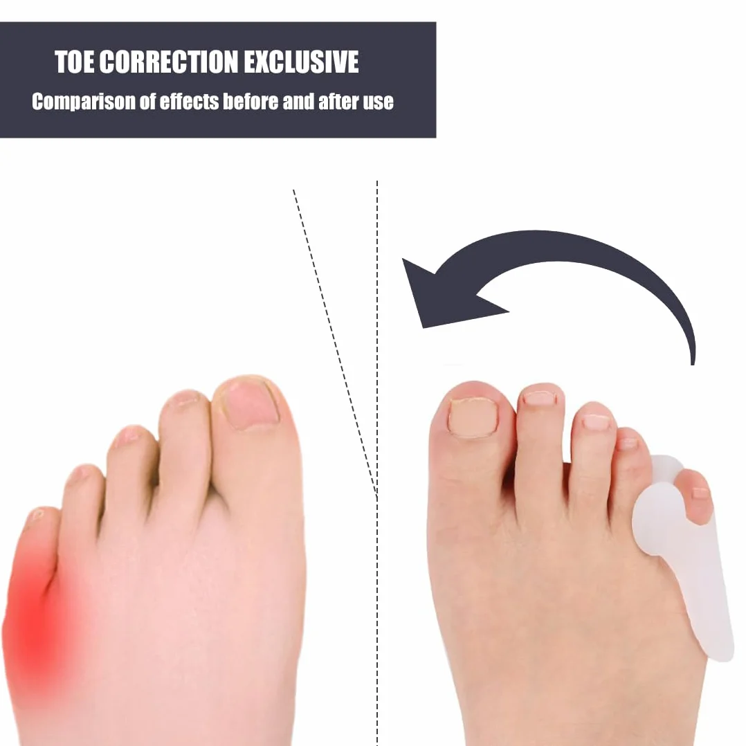 Alluce Valgo Correttore, Protezione Piccolo Dita, Separatore Dita Piede in Silicone per Camminare, Correre e Danza