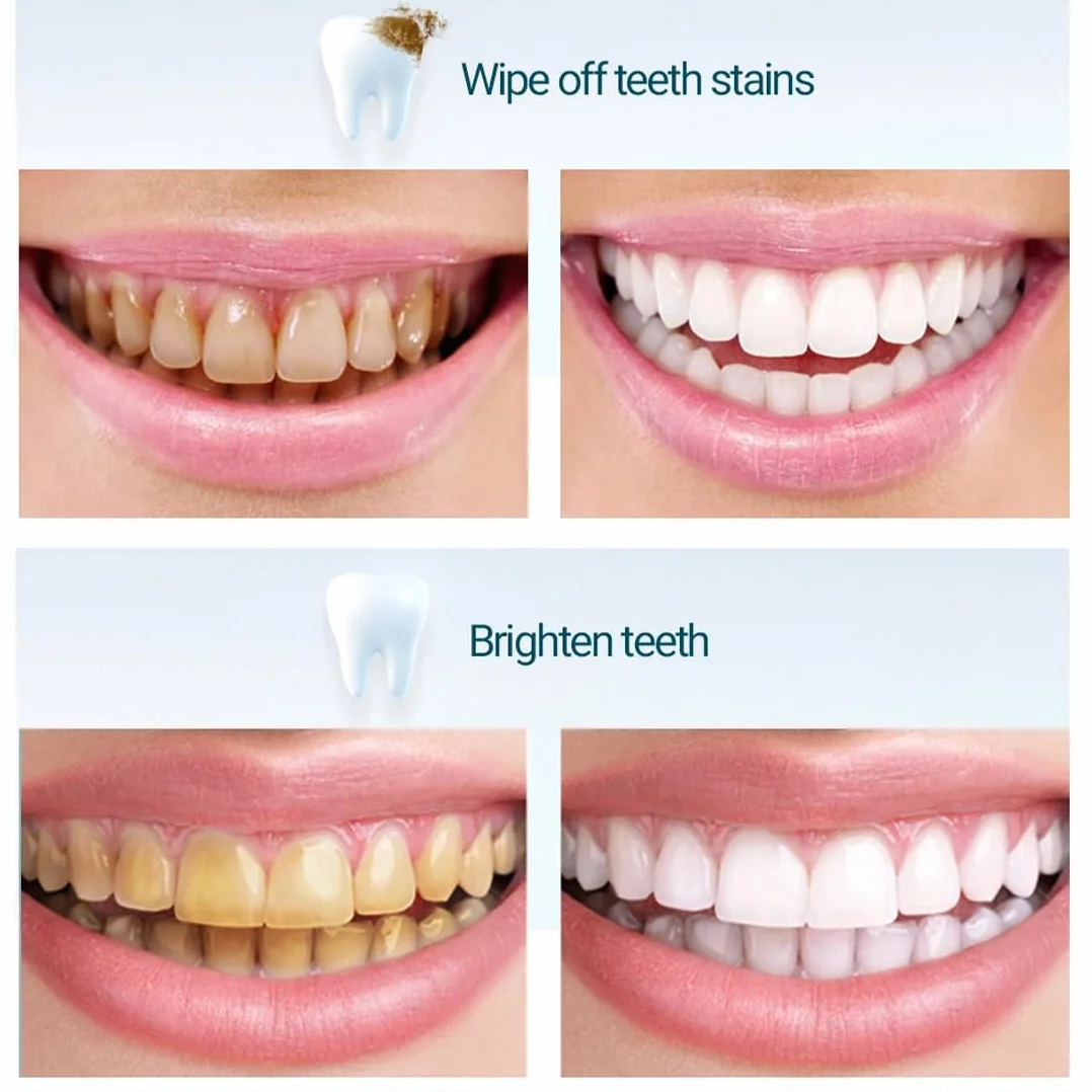 1 Scatola Carta Vetrata Dentale, Strisce Abrasive Interdentali, Carta Abrasiva Dentale Per Fessure, Strisce Per Lucidare I Denti Portatili, Lucidatura Dei Denti, Rimozione Del Tartaro