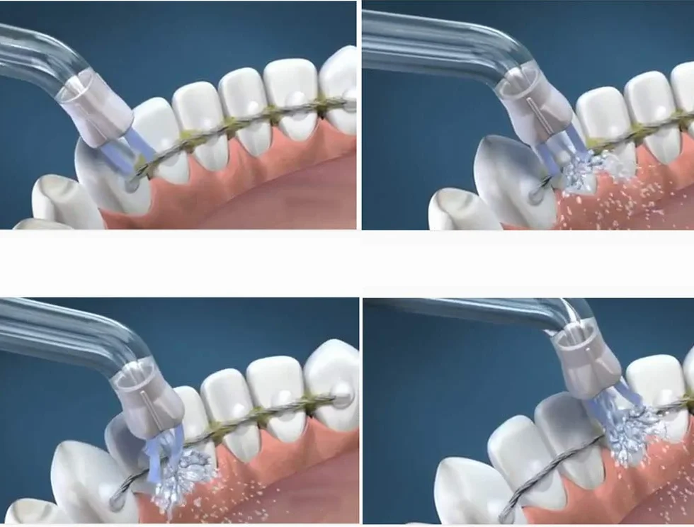Suggerimenti per la ricerca della placca di ricambio ad alta pressione per Waterpik WP-100 WP-250 WP-400 WP-660, Accessori ugelli, Parti di ricambio (4 pezzi)