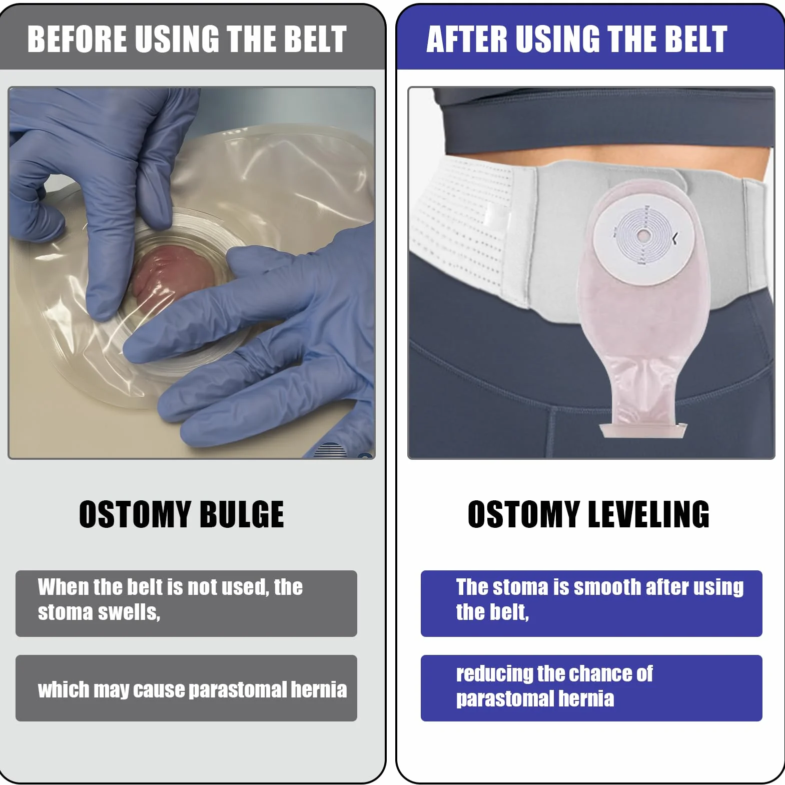 Cintura Stoma, cintura di supporto per stomia regolabile, cintura universale per colostomia e ileostomia, Cintura Per Colostomia, sacca per ileostomia, Forniture Per Stomia (XL)
