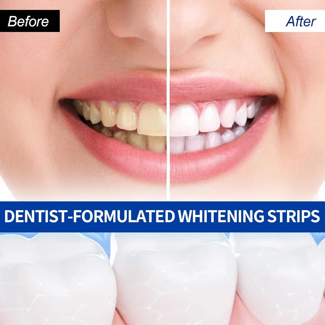 Strisce Sbiancanti Denti Professionale - 28 Strips Whitening per Sbiancamento,strisce sbiancanti denti, Delicate e Rapide, Rimuove le Macchie Profonde-A