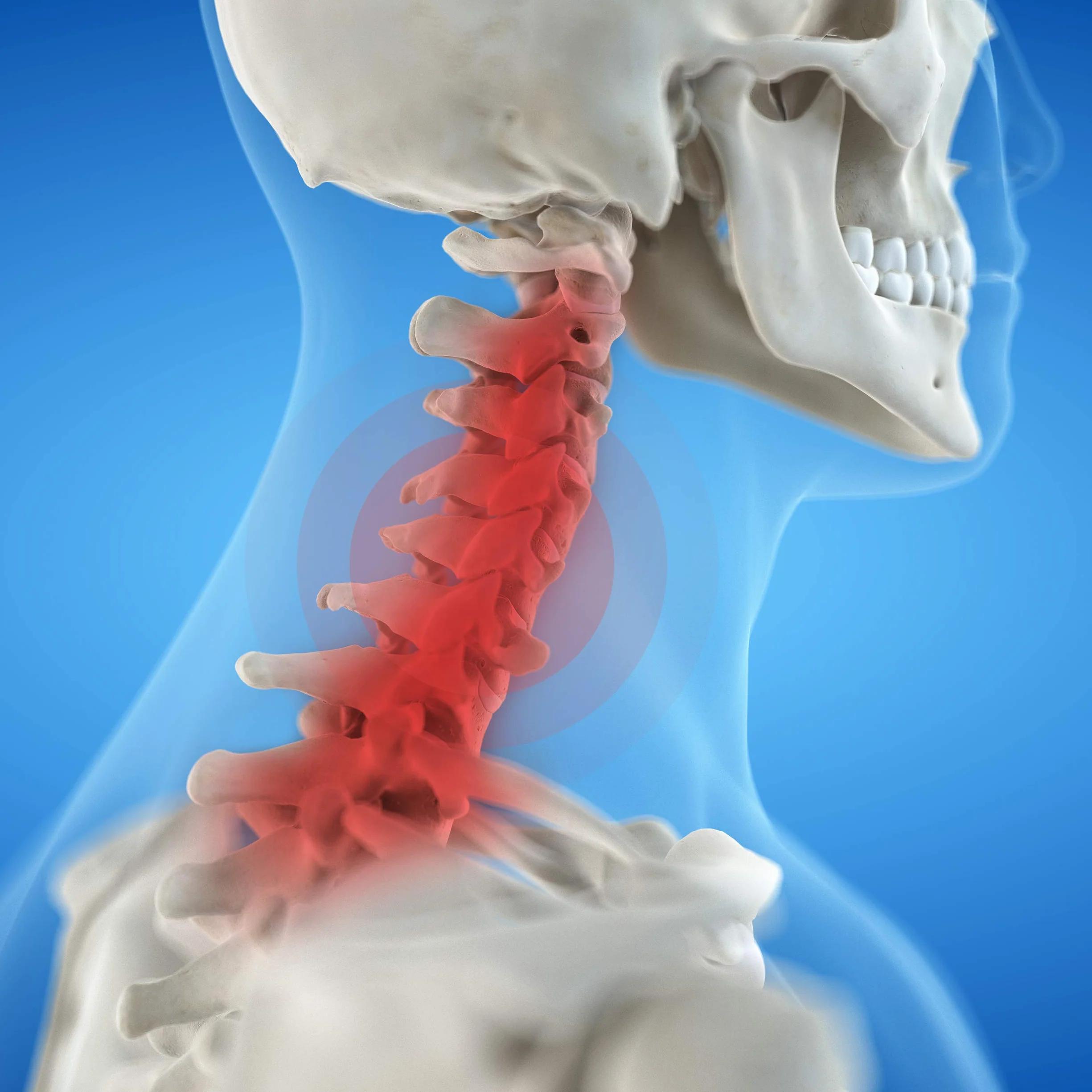 AIESI® Collare cervicale immobilizzante per adulti regolabile in 4 posizioni EASYLOCK
