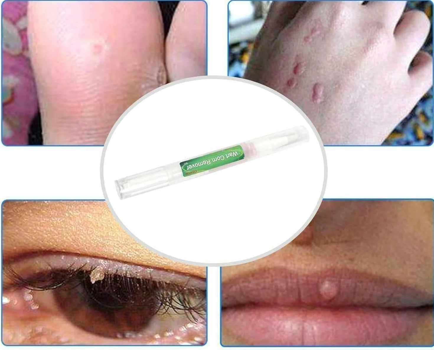 Genital Wart Treatment Papillomas Removal Liquid Wart Remover Pen 3ml