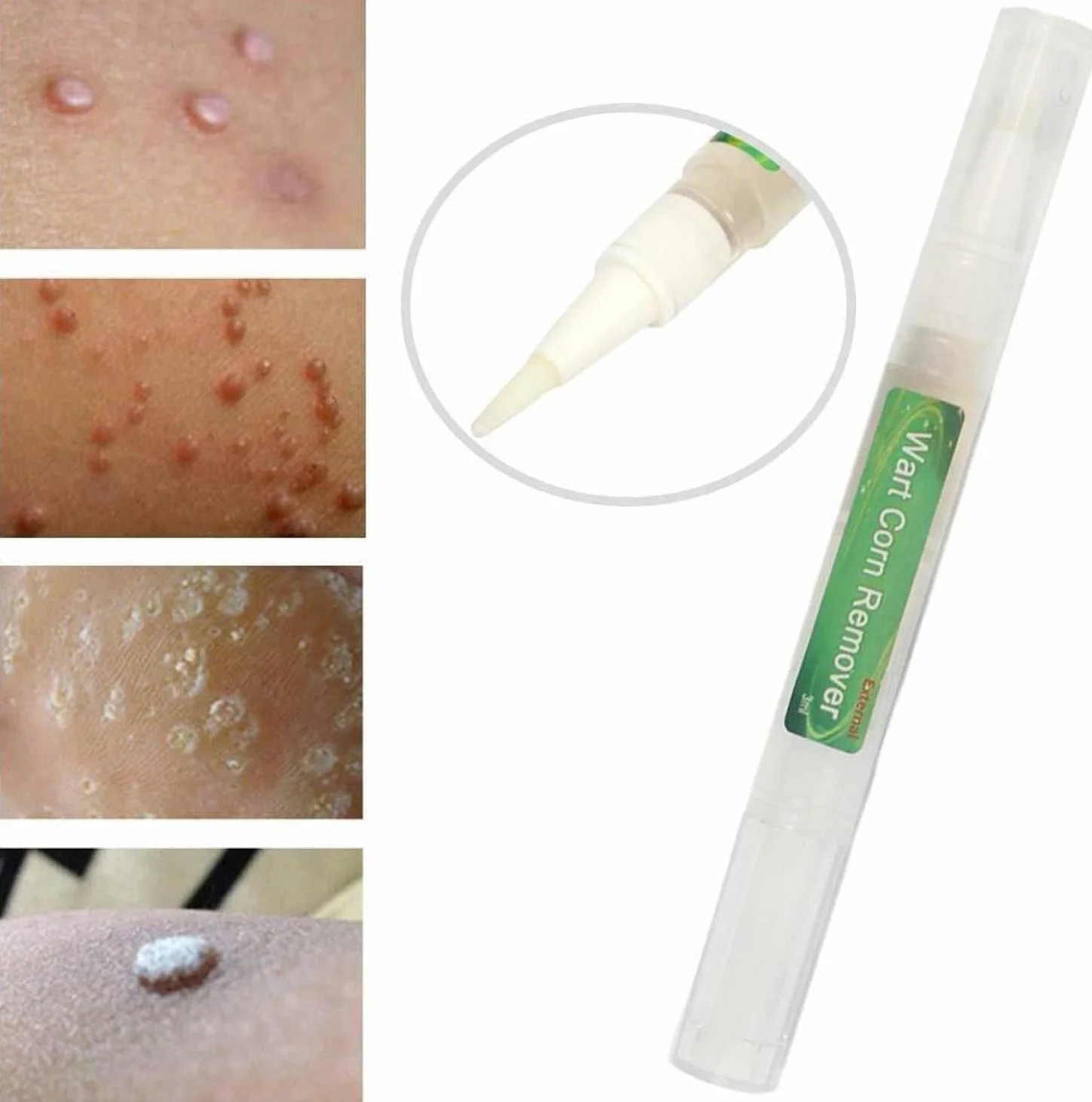 Genital Wart Treatment Papillomas Removal Liquid Wart Remover Pen 3ml