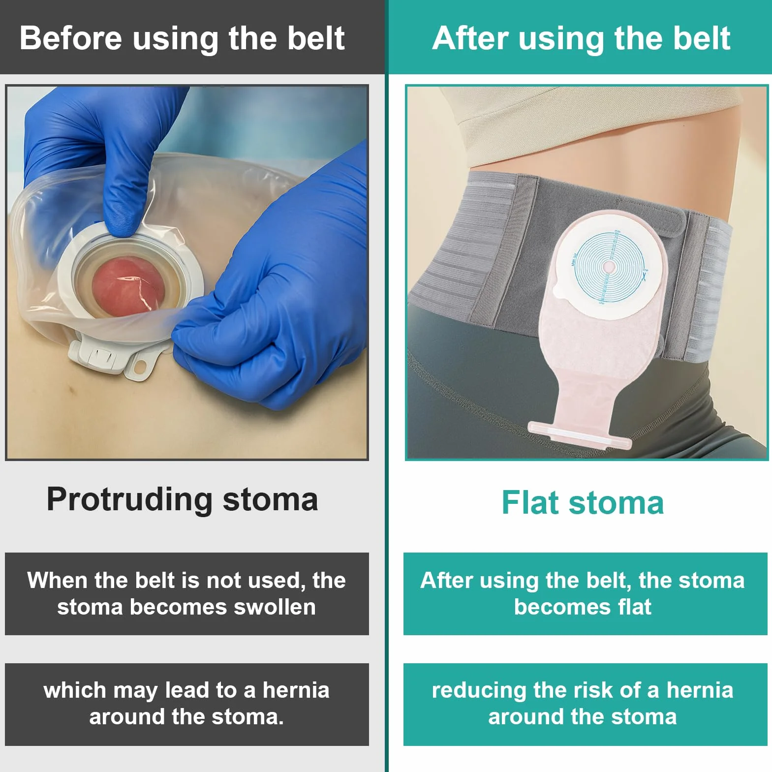 1 PCS Fascia Per Stomia Da Uomo E Donna, Cintura Per Stomia Larga 13 cm, Grigia Cintura Addominale Post Colostomia Per Prevenire L'ernia Parastomale, XL