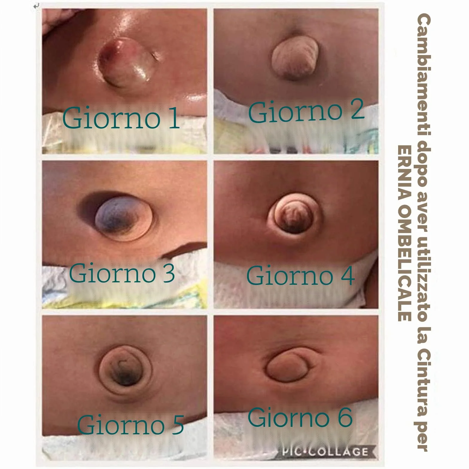 Fascia per ernia ombelicale nei neonati, supporto addominale per ombelico dei neonati, fascia regolabile blu Blu